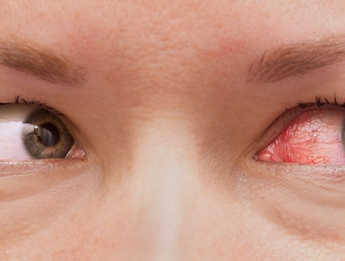 Eye_infections_and_contact_lenses_row_1