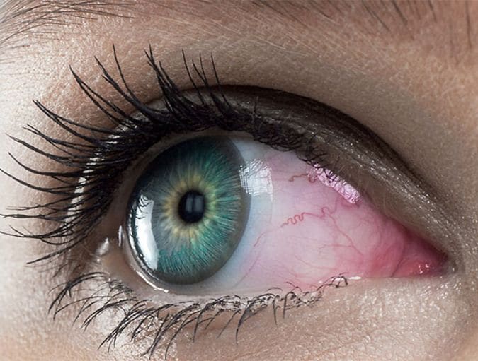 CMS_port-des-lentilles_lentilles-de-contact-et-yeux-rouges_FR_banner